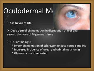 Oculodermal Melanocytosis
Aka Nevus of Ota
 Deep dermal pigmentation in distribution of first and
second divisions of Trigeminal nerve
 Ocular findings :-
* Hyper pigmentation of sclera,conjunctiva,cornea and iris
* Increased incidence of uveal and orbital melanomas
* Glaucoma is also reported
 