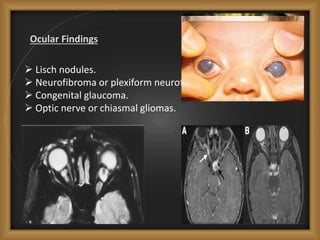 Ocular Findings
 Lisch nodules.
 Neurofibroma or plexiform neurofibroma of eyelid.
 Congenital glaucoma.
 Optic nerve or chiasmal gliomas.
 
