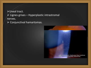 Uveal tract.
 Lignes grises – Hyperplastic intrastromal
nerves.
 Conjunctival hamartomas.
 
