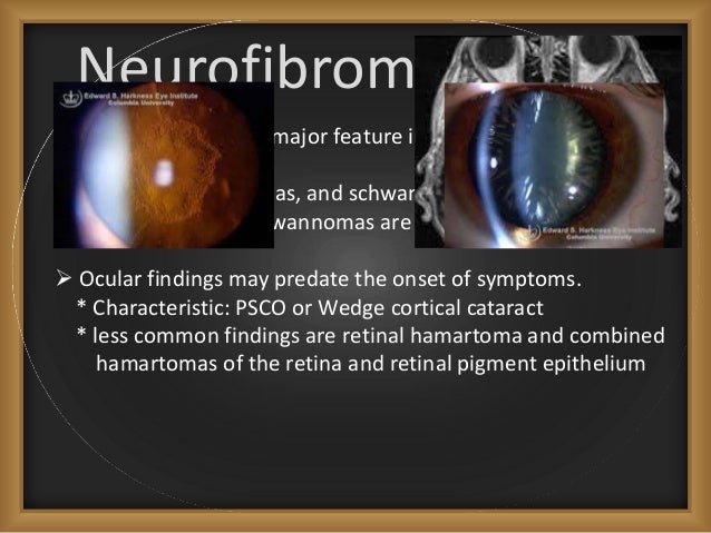 the signs and symptoms of neurofibromatoses 6-9-2000 the oncologist is a journal devoted to medical and practice issues the signs and symptoms of neurofibromatoses for surgical, radiation, and medical oncologists. the signs and symptoms of neurofibromatoses 6-9-2000 the oncologist is a journal devoted to medical and practice issues the signs and symptoms of neurofibromatoses for surgical, radiation, and medical oncologists.