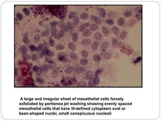 A large and irregular sheet of mesothelial cells forcely
exfoliated by peritonea jet washing showing evenly spaced
mesothelial cells that have ill-defined cytoplasm oval or
bean-shaped nuclei, small conspicuous nucleoli
 