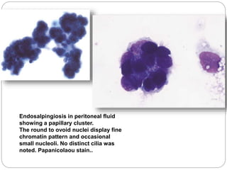 Endosalpingiosis in peritoneal fluid
showing a papillary cluster.
The round to ovoid nuclei display fine
chromatin pattern and occasional
small nucleoli. No distinct cilia was
noted. Papanicolaou stain..
 
