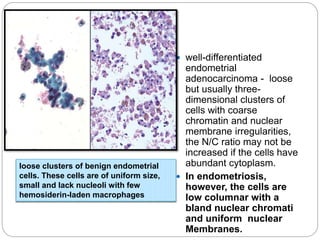 well-differentiated
endometrial
adenocarcinoma - loose
but usually three-
dimensional clusters of
cells with coarse
chromatin and nuclear
membrane irregularities,
the N/C ratio may not be
increased if the cells have
abundant cytoplasm.
 In endometriosis,
however, the cells are
low columnar with a
bland nuclear chromati
and uniform nuclear
Membranes.
loose clusters of benign endometrial
cells. These cells are of uniform size,
small and lack nucleoli with few
hemosiderin-laden macrophages
 