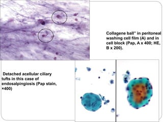 Collagene ball” in peritoneal
washing cell film (A) and in
cell block (Pap, A x 400; HE,
B x 200).
Detached acellular ciliary
tufts in this case of
endosalpingiosis (Pap stain,
×400)
 