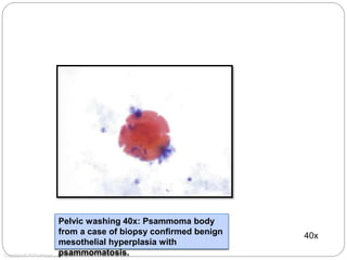 40x
Copyright © 2012 Hologic, All rights reserved.
Pelvic washing 40x: Psammoma body
from a case of biopsy confirmed benign
mesothelial hyperplasia with
psammomatosis.
 