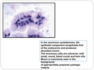 In the mucinous cystadenoma, the
epithelial component recapitulate that
of the endocervix and produces
abundant mucin.
The mucinous cells are columnar, with
small, round, bland nuclei and lack cilia
Mucin is commonly seen in the
background
of appropriately prepared cytologic
materia
 