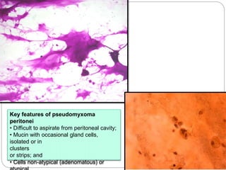 Key features of pseudomyxoma
peritonei
• Difficult to aspirate from peritoneal cavity;
• Mucin with occasional gland cells,
isolated or in
clusters
or strips; and
• Cells non-atypical (adenomatous) or
 