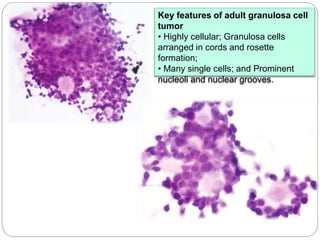 Key features of adult granulosa cell
tumor
• Highly cellular; Granulosa cells
arranged in cords and rosette
formation;
• Many single cells; and Prominent
nucleoli and nuclear grooves.
 