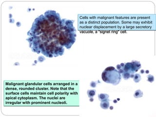 Malignant glandular cells arranged in a
dense, rounded cluster. Note that the
surface cells maintain cell polarity with
apical cytoplasm. The nuclei are
irregular with prominent nucleoli.
Cells with malignant features are present
as a distinct population. Some may exhibit
nuclear displacement by a large secretory
vacuole, a "signet ring" cell.
 