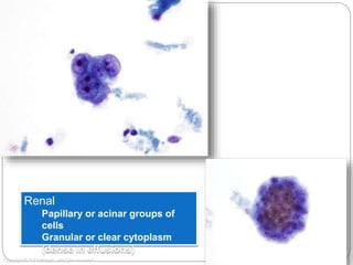 60x
Copyright © 2012 Hologic, All rights reserved.
Renal
Papillary or acinar groups of
cells
Granular or clear cytoplasm
(dense in effusions)
 