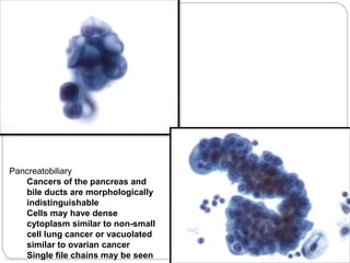60x
Copyright © 2012 Hologic, All rights reserved.
Pancreatobiliary
Cancers of the pancreas and
bile ducts are morphologically
indistinguishable
Cells may have dense
cytoplasm similar to non-small
cell lung cancer or vacuolated
similar to ovarian cancer
Single file chains may be seen
 