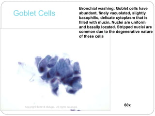 Goblet Cells
60xCopyright © 2012 Hologic, All rights reserved.
Bronchial washing: Goblet cells have
abundant, finely vacuolated, slightly
basophilic, delicate cytoplasm that is
filled with mucin. Nuclei are uniform
and basally located. Stripped nuclei are
common due to the degenerative nature
of these cells
 