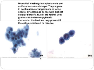 60
x
60x
Copyright © 2012 Hologic, All rights reserved Copyright © 2012 Hologic, All rights reserved
Bronchial washing: Metaplasia cells are
uniform in size and shape. They appear
in cobblestone arrangements or loose
sheets, cytoplasm is dense with distinct
cellular borders. Nuclei are round, with
granular to coarse or pyknotic
chromatin. Nucleoli are only present if
the cells are irritated or reactive.
 