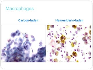 Macrophages
Carbon-laden Hemosiderin-laden
Copyright © 2012 Hologic, All rights reserved Copyright © 2012 Hologic, All rights reserved
 