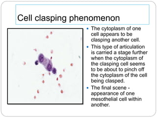 Cell clasping phenomenon
 The cytoplasm of one
cell appears to be
clasping another cell.
 This type of articulation
is carried a stage further
when the cytoplasm of
the clasping cell seems
to be about to pinch off
the cytoplasm of the cell
being clasped.
 The final scene -
appearance of one
mesothelial cell within
another.
 