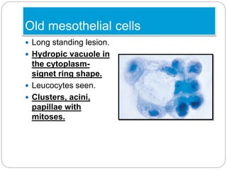 Old mesothelial cells
 Long standing lesion.
 Hydropic vacuole in
the cytoplasm-
signet ring shape.
 Leucocytes seen.
 Clusters, acini,
papillae with
mitoses.
 