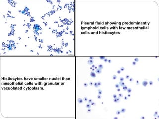 Histiocytes have smaller nuclei than
mesothelial cells with granular or
vacuolated cytoplasm.
Pleural fluid showing predominantly
lymphoid cells with few mesothelial
cells and histiocytes
 