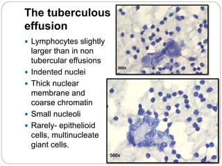 The tuberculous
effusion
 Lymphocytes slightly
larger than in non
tubercular effusions
 Indented nuclei
 Thick nuclear
membrane and
coarse chromatin
 Small nucleoli
 Rarely- epithelioid
cells, multinucleate
giant cells.
 