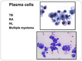 Plasma cells
TB
RA
HL
Multiple myeloma
 