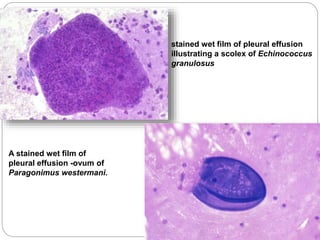stained wet film of pleural effusion
illustrating a scolex of Echinococcus
granulosus
A stained wet film of
pleural effusion -ovum of
Paragonimus westermani.
 