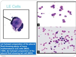 LE Cells
Image reprinted with permission from MLO-Medical Laboratory Observer, November 2008.
(a) Cytospin preparation of the pleural
fluid showing plenty of lupus
erythematosus (LE) cells (MGG,
×400). (b) Cytospin preparation of the
pleural fluid showing tart cell (MGG,
×400)
 
