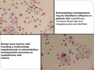 Benign bone marrow cells
including a multinucleate
megakaryocyte in extramedullary
hematopoiesis secondary to
myelofibrosis with
anemia.
Extramedullary hematopoiesis
may be identified in effusions in
patients with myelofibrosis.
Immature blood cells and
megakaryocytes are identified
 