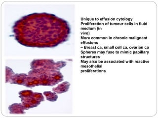 Unique to effusion cytology
Proliferation of tumour cells in fluid
medium (in
vivo)
More common in chronic malignant
effusions
– Breast ca, small cell ca, ovarian ca
Spheres may fuse to mimic papillary
structures
May also be associated with reactive
mesothelial
proliferations
 