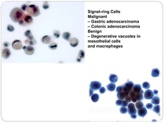 Signet-ring Cells
Malignant
– Gastric adenocarcinoma
– Colonic adenocarcinoma
Benign
– Degenerative vacuoles in
mesothelial cells
and macrophages
 