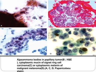 A)psammoma bodies in papillary tumor(B ; H&E
), cytoplasmic mucin of signet ring cell
carcinoma(C) or cytoplasmic melanin of
malignant melanoma(D).(A, C, D; Papanicolaou
stain).
 