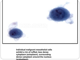 Individual malignant mesothelial cells
exhibit a rim of ruffled, less dense
cytoplasm (ectoplasm), surrounding
dense cytoplasm around the nucleus
(endoplasm).
 