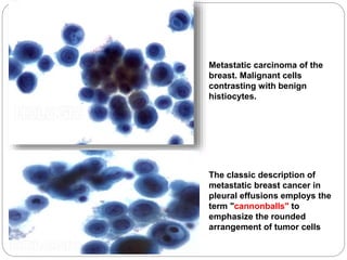Metastatic carcinoma of the
breast. Malignant cells
contrasting with benign
histiocytes.
The classic description of
metastatic breast cancer in
pleural effusions employs the
term "cannonballs" to
emphasize the rounded
arrangement of tumor cells
 