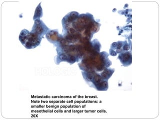 Metastatic carcinoma of the breast.
Note two separate cell populations: a
smaller benign population of
mesothelial cells and larger tumor cells.
20X
 