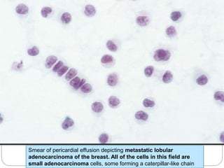 Smear of pericardial effusion depicting metastatic lobular
adenocarcinoma of the breast. All of the cells in this field are
small adenocarcinoma cells, some forming a caterpillar-like chain
 