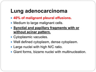 Lung adenocarcinoma
 40% of malignant pleural effusions.
 Medium to large malignant cells.
 Synctial and papillary fragments with or
without acinar pattern.
 Cytoplasmic vacuoles.
 Well defined cytoplasm, dense cytoplasm.
 Large nuclei with high N/C ratio.
 Giant forms, bizarre nuclei with multinucleation.
 