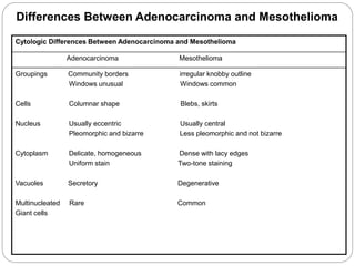 Cytologic Differences Between Adenocarcinoma and Mesothelioma
Adenocarcinoma Mesothelioma
Groupings Community borders irregular knobby outline
Windows unusual Windows common
Cells Columnar shape Blebs, skirts
Nucleus Usually eccentric Usually central
Pleomorphic and bizarre Less pleomorphic and not bizarre
Cytoplasm Delicate, homogeneous Dense with lacy edges
Uniform stain Two-tone staining
Vacuoles Secretory Degenerative
Multinucleated Rare Common
Giant cells
Differences Between Adenocarcinoma and Mesothelioma
 