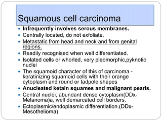 Squamous cell carcinoma
 Infrequently involves serous membranes.
 Centrally located, do not exfoliate.
 Metastatic from head and neck and from genital
regions.
 Readily recognised when well differentiated.
 Isolated cells or whorled, very pleomorphic,pyknotic
nuclei
 The squamoid character of this of carcinoma -
keratinizing squamoid cells with their orange
cytoplasm and round or tadpole shapes
 Anucleated ketain squames and malignant pearls.
 Central nuclei, abundant dense cytoplasm(DDx-
Melanoma)a, well demarcated cell borders.
 Ectoplasmic/endoplasmic differentiation.(DDx-
Mesothelioma)
 