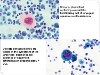 Smear of pleural fluid
containing a metastatic
keratinizing cell of laryngeal
squamous cell carcinoma
Delicate concentric lines are
visible in the cytoplasm of the
larger cell; such lines are
evidence of squamoid
differentiation (Papanicolaou ×
OL).
 