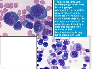 The cells are large with
markedly atypical features
including large
pleomorphic nuclei which
may be lobated, one or
more prominent nucleoli,
and abundant amphophilic
cytoplasmm. anaplastic or
plasmablastic including a
pale area alongside the
nucleus or 'hof'.
Multinucleated cells may
be confused with Reed
Sternberg cells. Mitoses
are frequent.
 