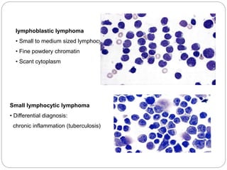lymphoblastic lymphoma
• Small to medium sized lymphocytes
• Fine powdery chromatin
• Scant cytoplasm
Small lymphocytic lymphoma
• Differential diagnosis:
chronic inflammation (tuberculosis)
 
