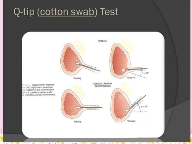 Stress Urinary Incontinence