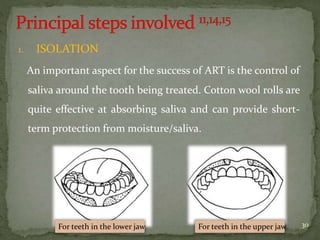 1. ISOLATION
An important aspect for the success of ART is the control of
saliva around the tooth being treated. Cotton wool rolls are
quite effective at absorbing saliva and can provide short-
term protection from moisture/saliva.
2/27/2016 30For teeth in the lower jaw For teeth in the upper jaw
 
