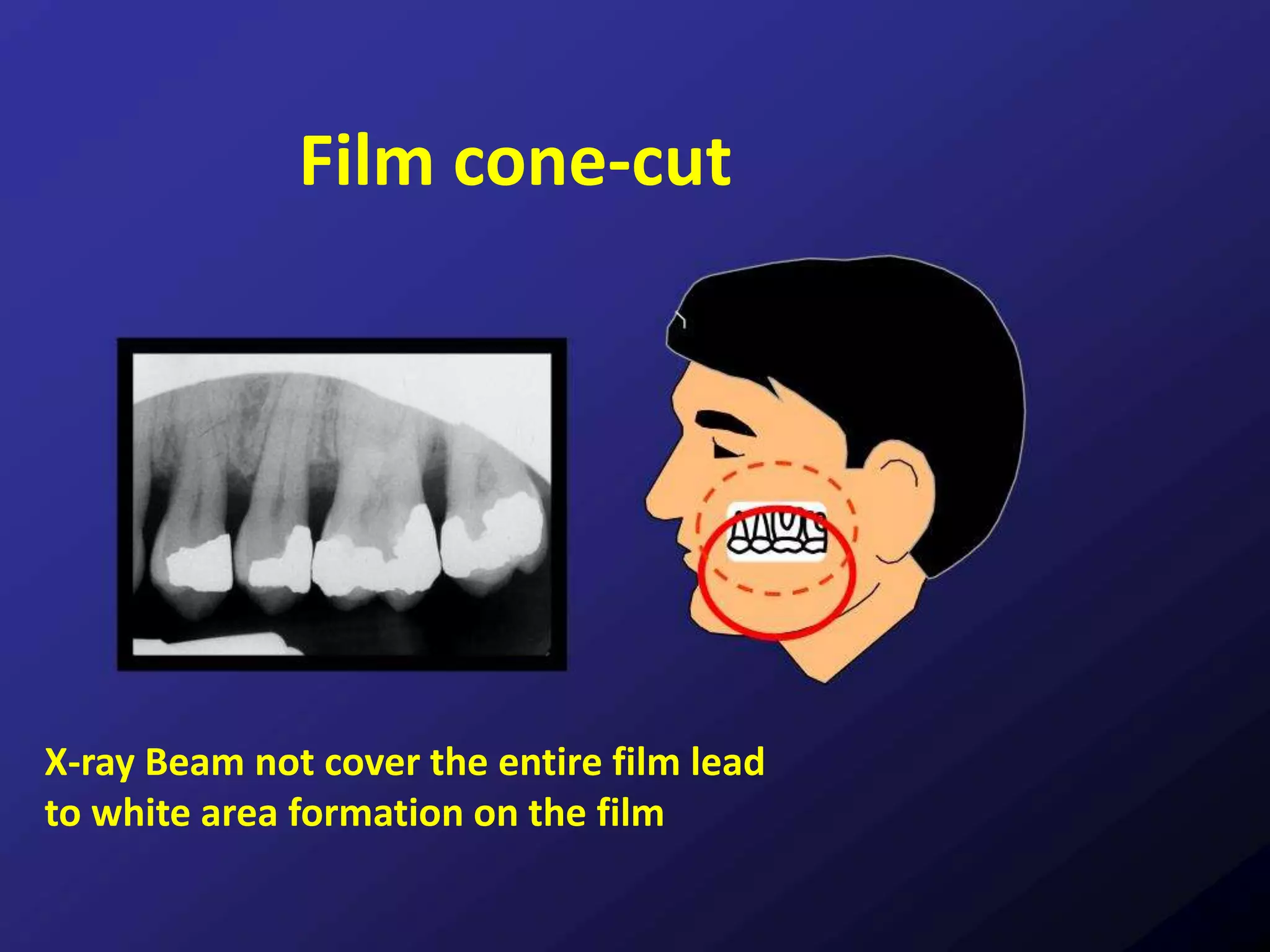 Film cone-cut
X-ray Beam not cover the entire film lead
to white area formation on the film
