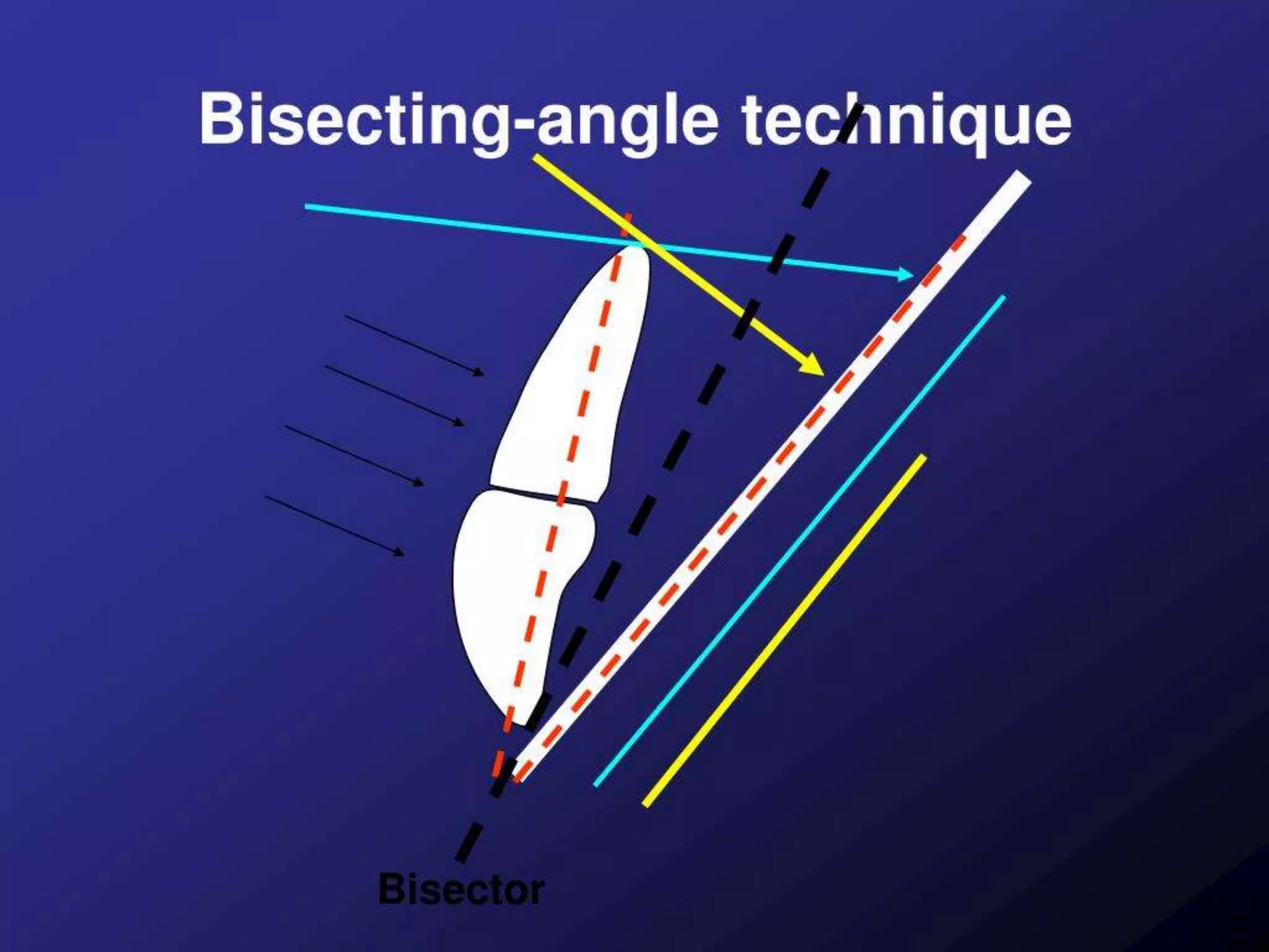 Bisecting angle technique | PPTX