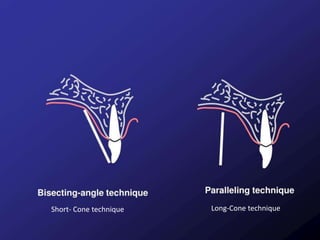 Tooth Bisection Bisecting angle technique | PPTX