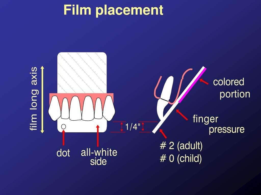 Bisecting angle technique
