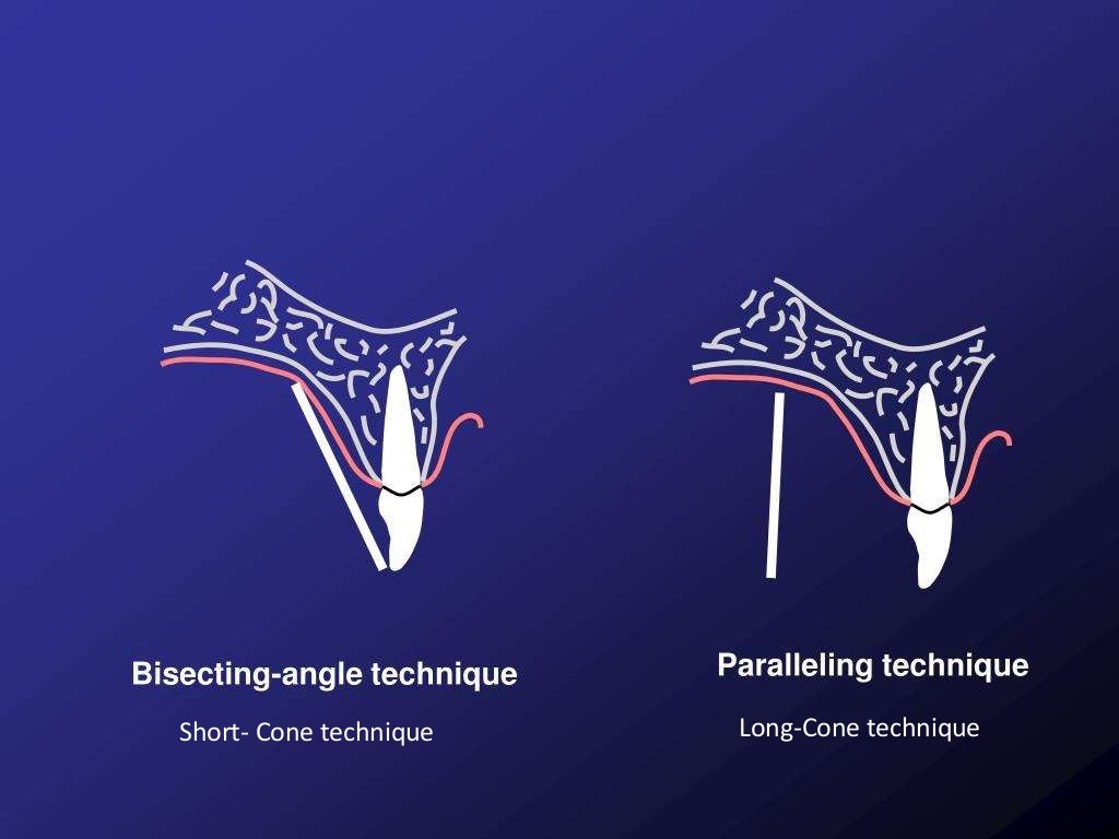 Bisecting angle technique