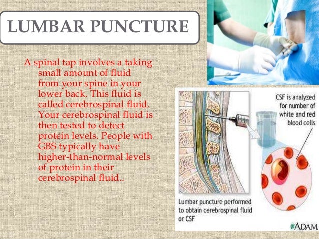 Guillian Barre Syndrome