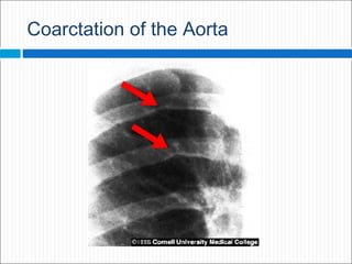 Treatment
 untreated, coarctation of the aorta has a poor natural history.
 natural history data for untreated coarctati...