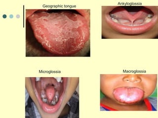 Ankyloglossia
Microglossia Macroglossia
Geographic tongue
 