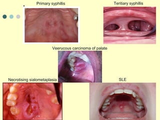 Teritiary syphillisPrimary syphillis
Necrotising sialometaplasia SLE
Veerucous carcinoma of palate
 